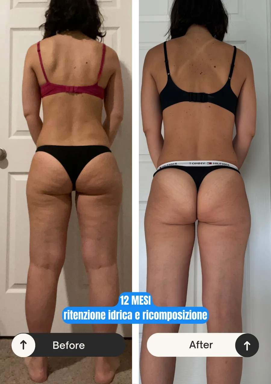 Prima e dopo: 12 mesi, ritenzione idrica e ricomposizione (donna)